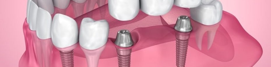 know all about dental implants