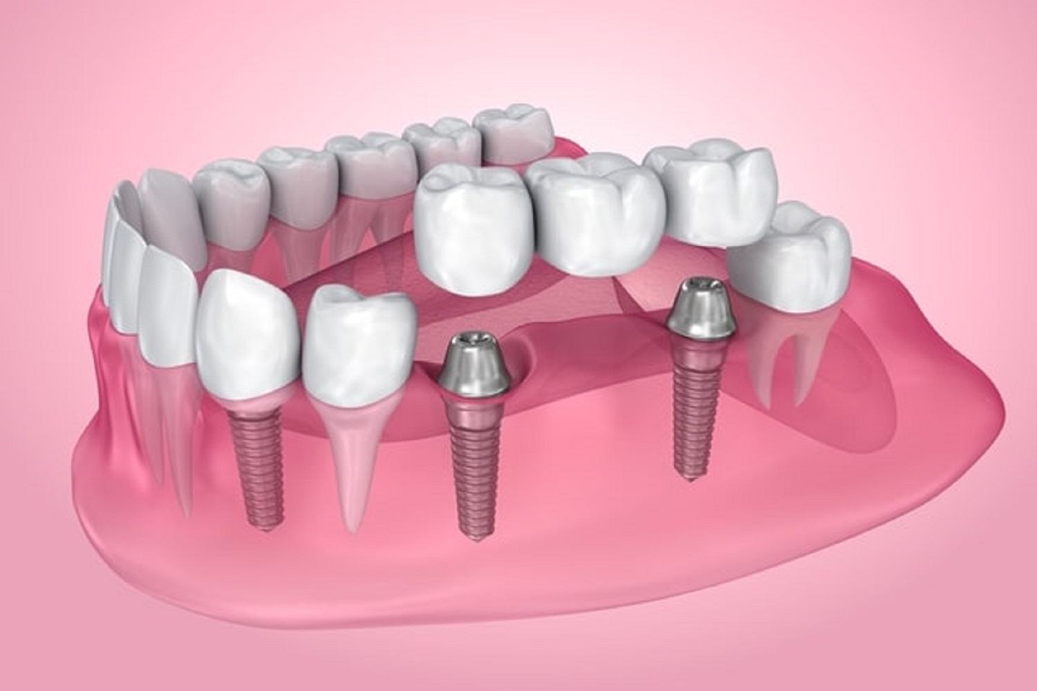 know all about dental implants