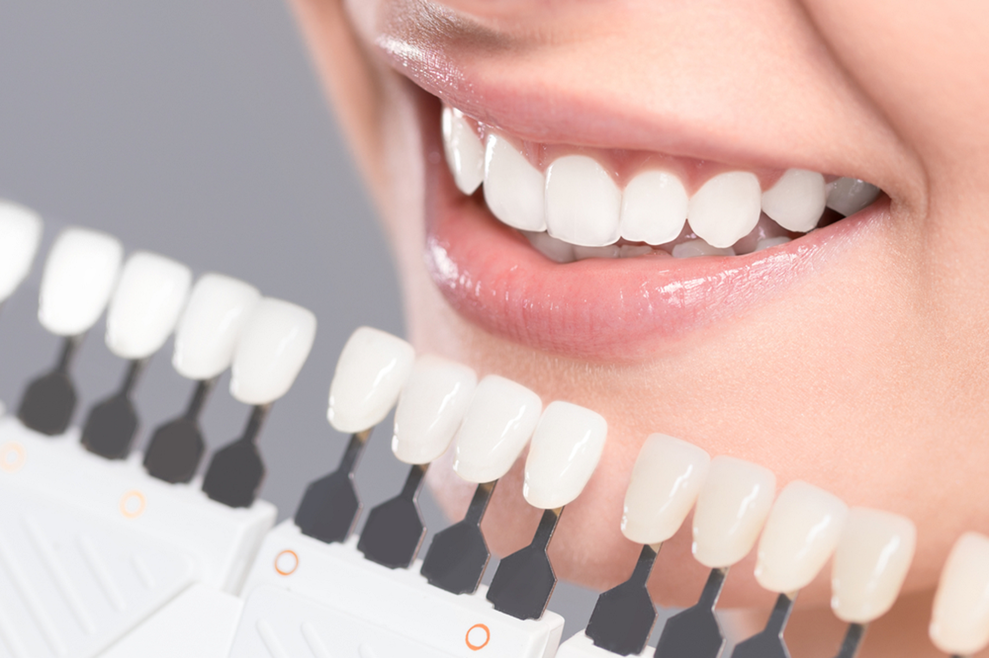 facts about porcelain veneers